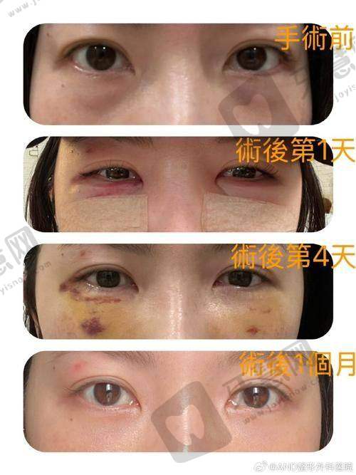 北京空美圣医整形自体脂肪丰泪沟 20750 元起项目简介