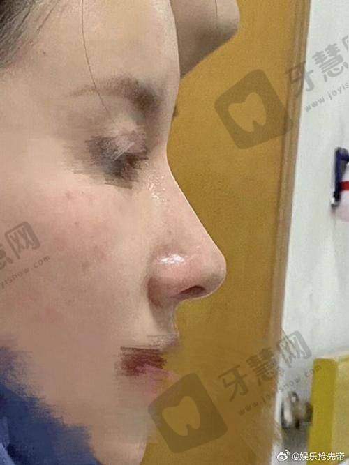 北京芳园整形自体脂肪丰耳垂 6750 元起顾客实例