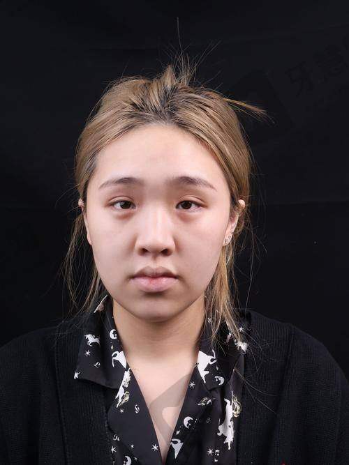 北京鼻孔不对称矫正十大医院——北京协和整形美容医院