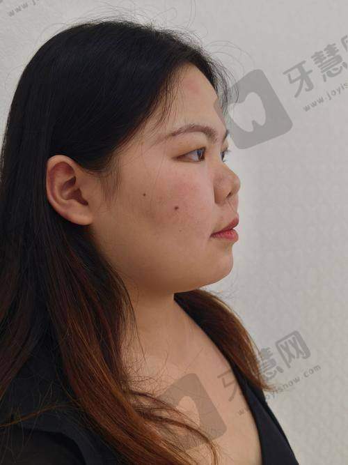 北京鼻基底填充排名前十——北京柏丽医疗美容门诊部