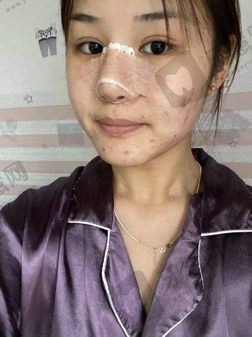 北京驼峰鼻矫正排名前十——北京星灿宫医疗美容