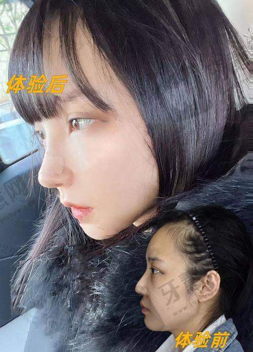 北京鼻基底填充排名前十——北京沃尔医疗美容诊所