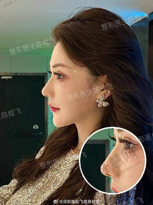 北京鼻孔不对称矫正十大医院：2025榜单揭晓——八大处/协和/正美等正规机构入选