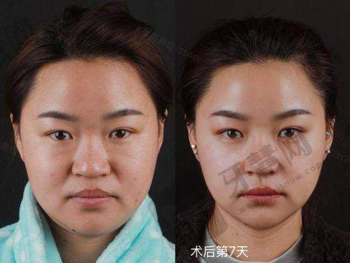 北京肋骨鼻综合整形十大医院——北京沃尔刘彦军整形美容