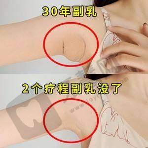 北京吸脂去副乳排名前十——北京沃尔医疗美容诊所
