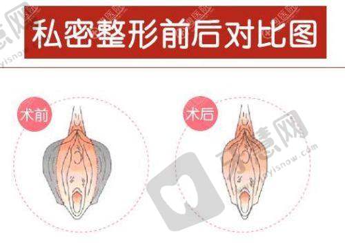 北京泰美丽格美容小阴唇整形 13750 元起预约方式