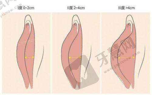 北京泰美丽格美容小阴唇整形 13750 元起项目优势解读