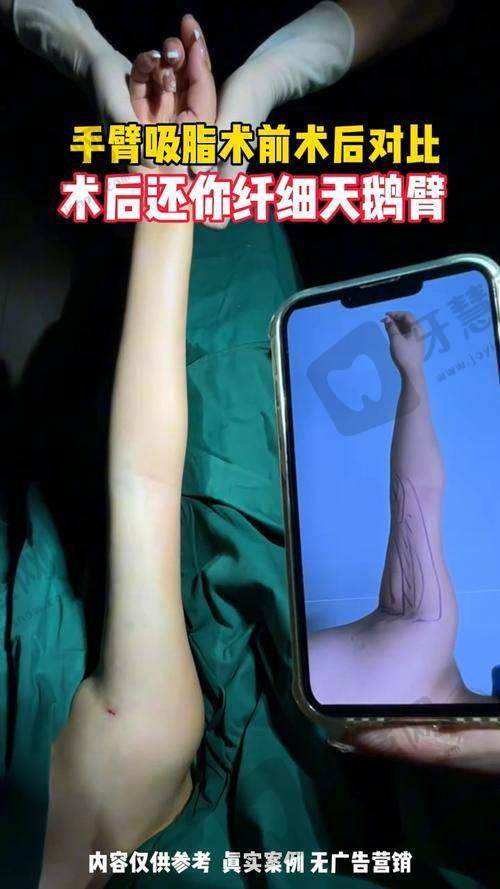 北京肩膀吸脂前十的医院之北京润美玉之光医疗美容