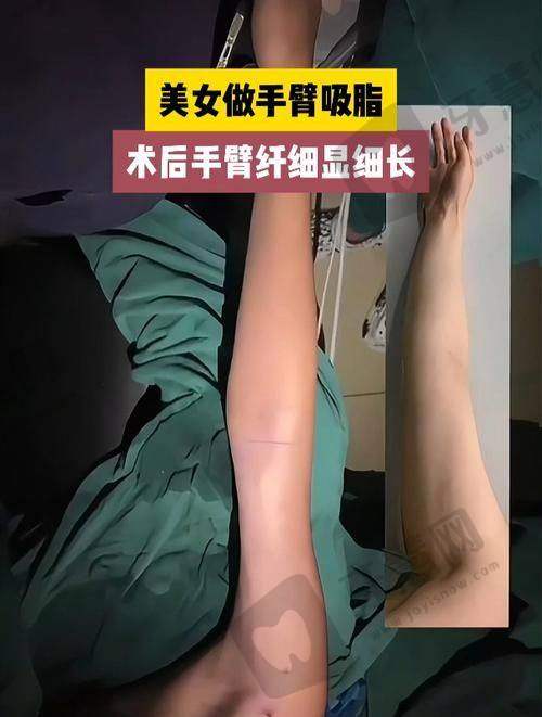 北京背部吸脂排名前十：东方和谐、樱桃医疗、八大处有擅长医生