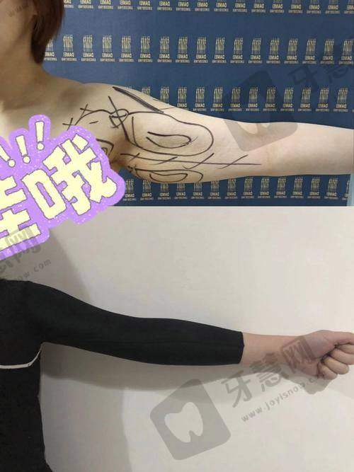 北京肩膀吸脂前十的医院之北京纯脂医疗美容