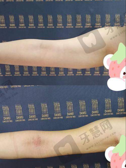 北京肩膀吸脂前十的医院之北京煤医西坝河医疗美容