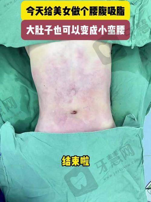 北京美莱医疗美容医院——大型连锁全身吸脂机构