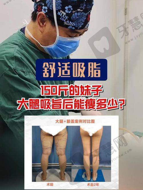 北京膝盖内侧吸脂十大医院——北京京美医疗美容