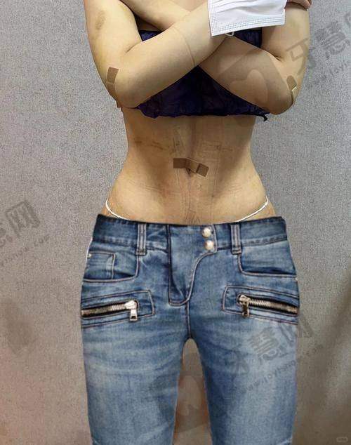 北京富贵包吸脂排名前十——北京嘉禾医疗美容医院