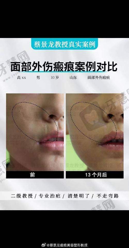 北京挛缩鼻修复排名前十——北京沃尔医疗美容