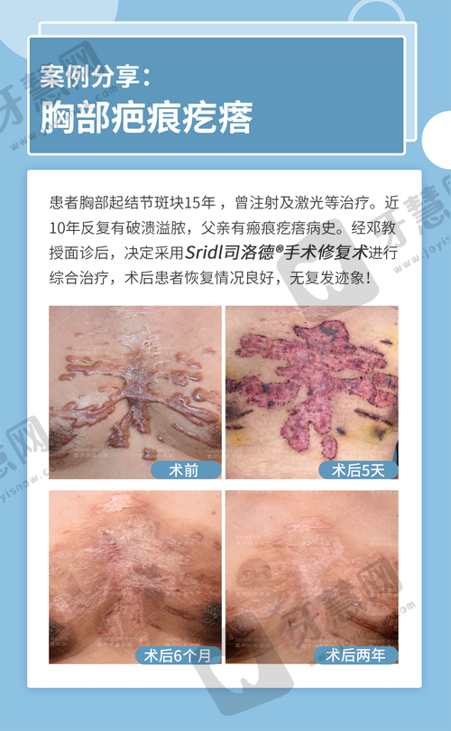 北京挛缩鼻修复排名前十——北京宫国华医疗美容