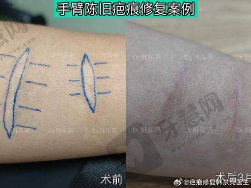 北京挛缩鼻修复排名前十——北京米兰柏羽丽都整形医院