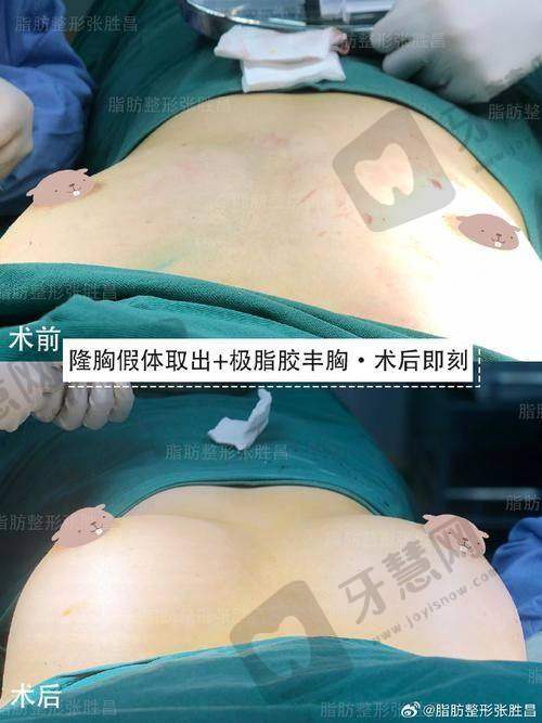 北京脂肪胶丰胸前十的医院公布——北京禾美嘉