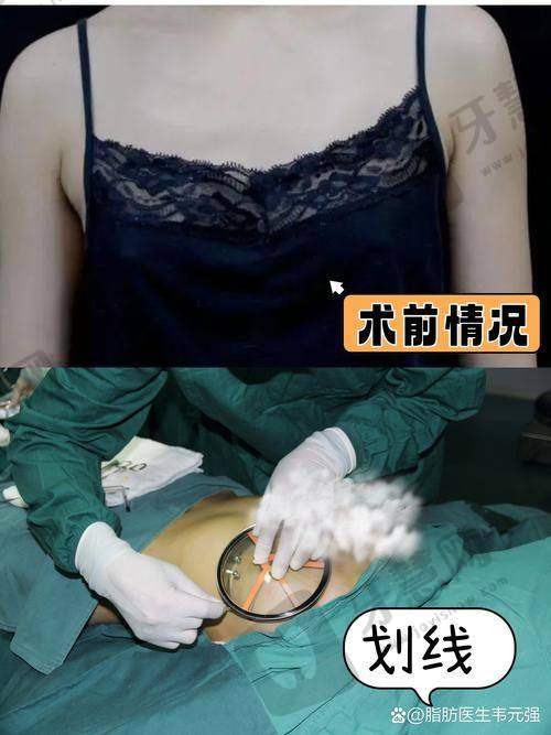 北京脂肪胶丰胸前十的医院公布——北京润美玉之光
