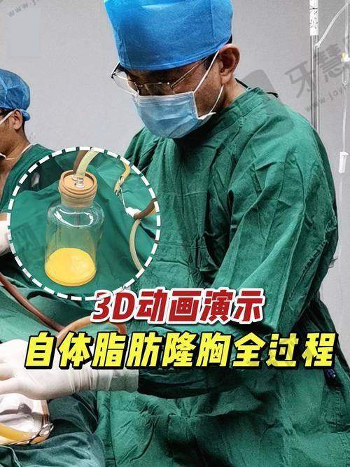 北京脂肪胶丰胸前十的医院公布——北京纯脂