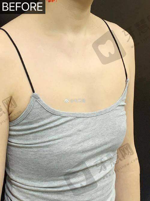 北京空美圣医整形自体脂肪丰泪沟 20750 元起顾客实例