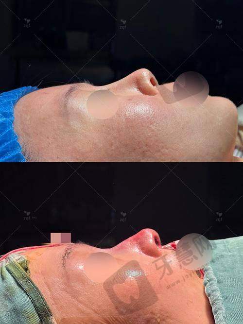 北京硅胶假体隆鼻修复十大医院：米扬丽格/中加科洋等医院及医生擅长汇总