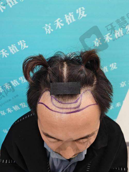 北京百达丽美容皮肤软组织扩张 43750 元起之顾客实例