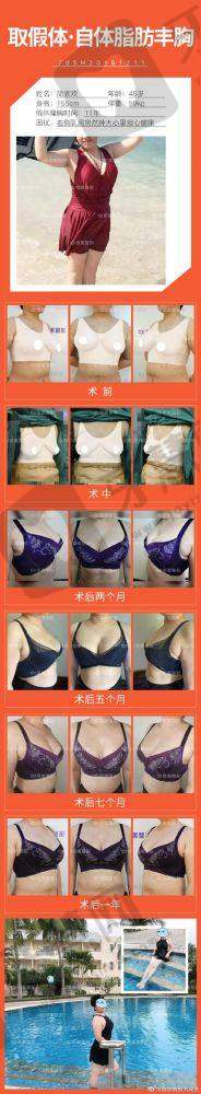 北京乳房下垂矫正十大排医生院——北京米兰柏羽丽都医疗美容医院