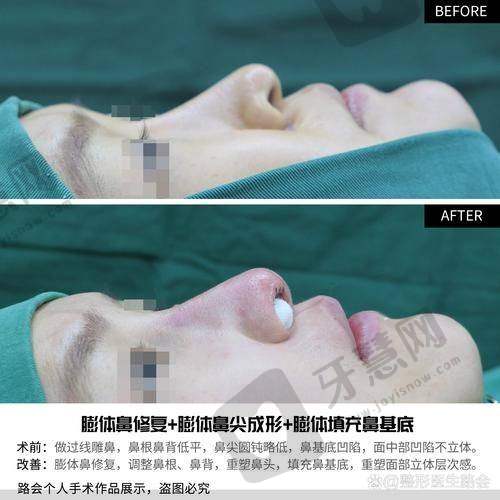 北京鼻基底填充排名前十——北京米扬丽格医疗美容