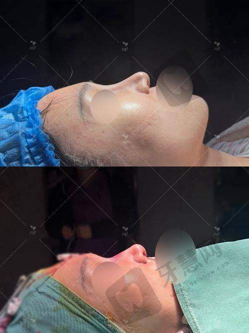 北京鼻基底填充排名前十——北京八大处整形外科医院