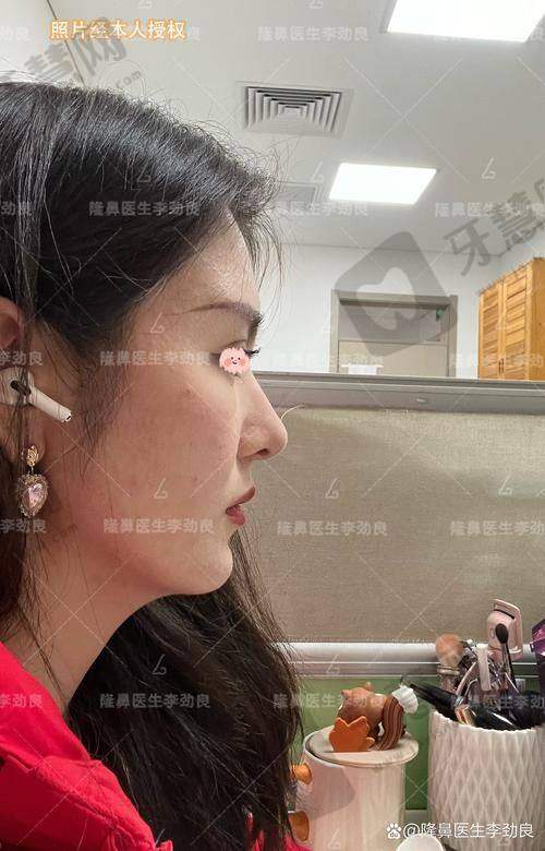 北京挛缩鼻修复排名前十——北京柏丽医疗美容