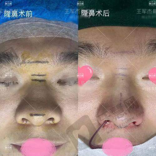 北京肋骨鼻综合整形十大医院——北京宫国华医疗美容诊所