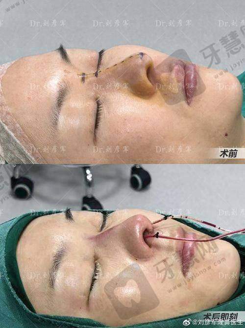 北京鞍鼻矫正前十的医院——北京伊美尔健翔整形美容医院