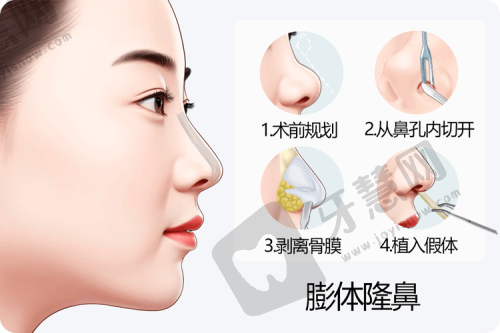 北京挛缩鼻修复排名前十——北京煤医西坝河整形医院