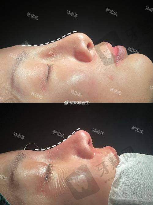 北京挛缩鼻修复排名前十——北京美莱医疗美容医院