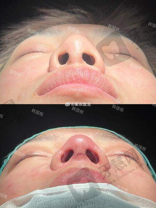 北京肋骨鼻综合整形十大医院——北京米扬丽格医疗美容