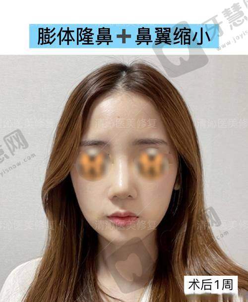 北京驼峰鼻矫正排名前十——北京惠美医疗美容门诊部