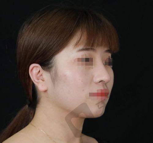 北京驼峰鼻矫正排名前十——北京美莱