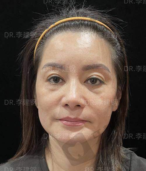 北京沃尔刘彦军整形美容——院长技术高超的骨粉取出医院