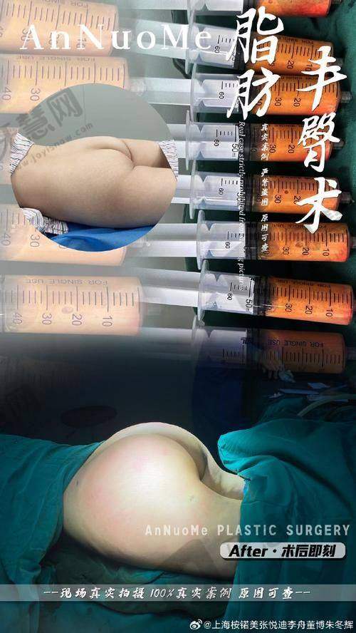 北京自体脂肪丰唇排名前十——北京画美医疗美容医院