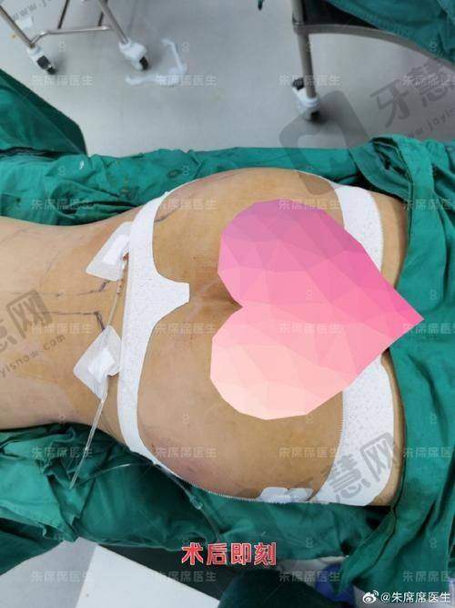 北京自体脂肪丰唇排名前十——北京联合丽格第一医疗美容医院