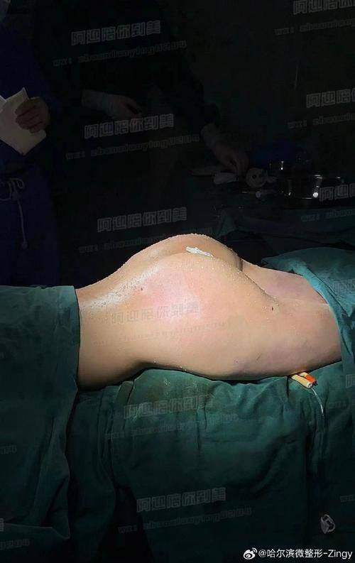 北京自体脂肪丰唇排名前十——北京润美玉之光医疗美容门诊部