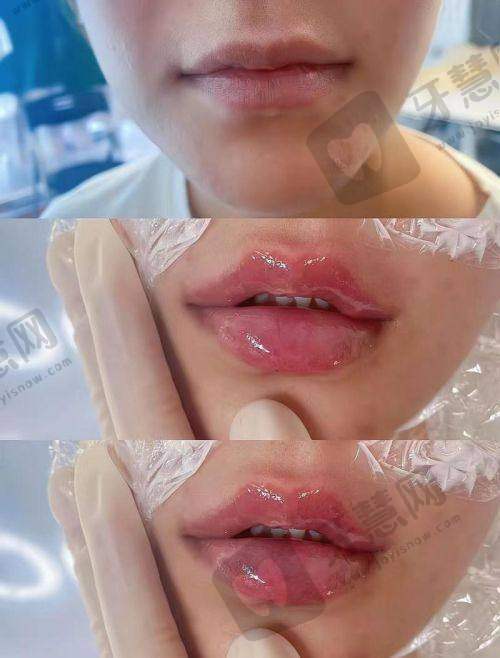 北京姣兰注射法定认证医院十大医院——北京沃尔刘彦军整形