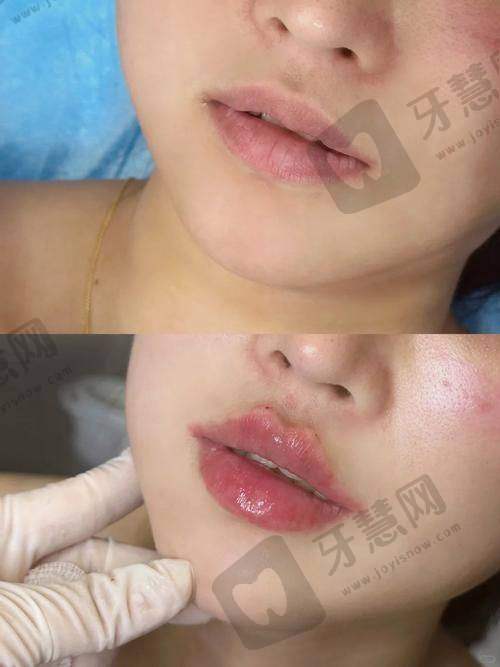 北京芙媄登注射法定认证医院——北京京城皮肤医院