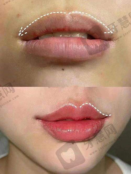 北京芙媄登注射法定认证医院——国内医学科学 院整形外科医院 - 激光美容中 心