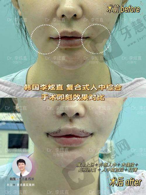 北京自体脂肪丰唇排名前十——北京美莱医疗美容医院
