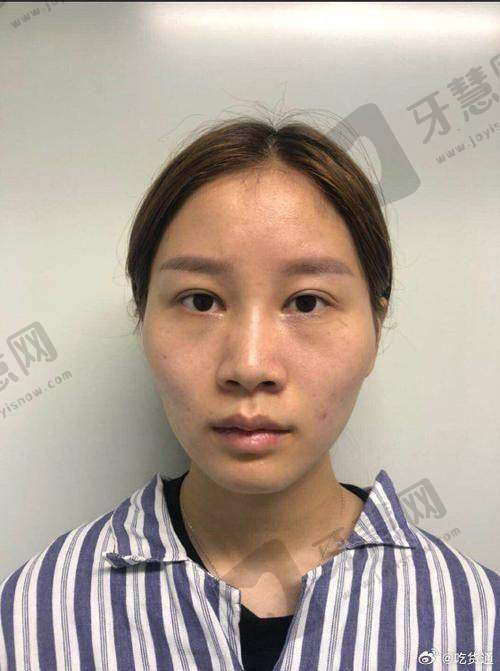 海口焕颜整形医院价格表