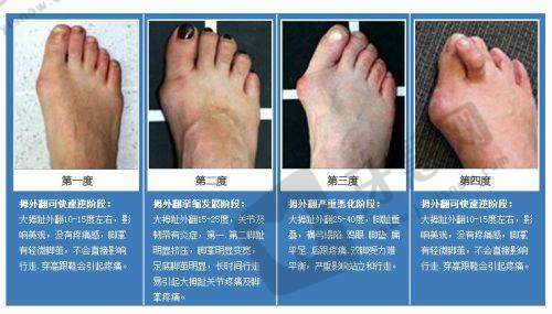长沙雅美整形田芳斌怎么预约？电话/微信/官网预约方式+田芳斌双眼皮修复案例分享