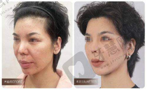 强生蓝钻鱼骨线的产品特点
