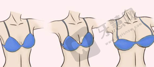 强生蓝钻鱼骨线什么价位？与童颜线区别几何、效果谁更优？